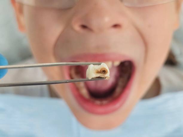Best Emergency Dental Extractions in Mascotte, FL